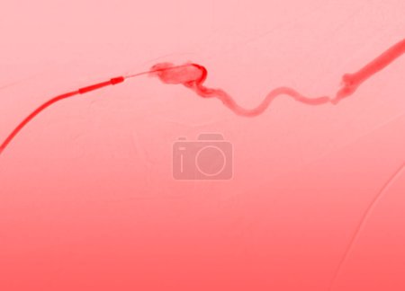 Foto de La angioplastia con balón es un procedimiento médico que se usa para ensanchar los vasos sanguíneos estrechos u obstruidos.. - Imagen libre de derechos