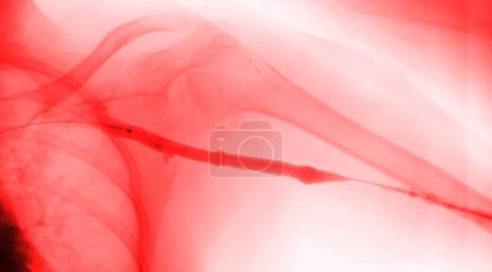 Foto de La angioplastia con balón es un procedimiento médico que se usa para ensanchar los vasos sanguíneos estrechos u obstruidos.. - Imagen libre de derechos