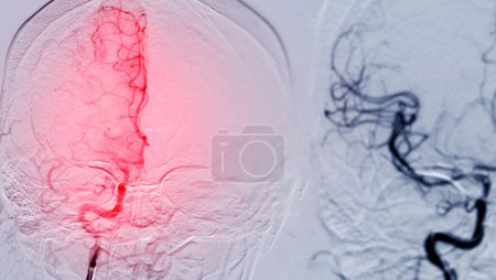 Photo for A cerebral angiogram is a medical imaging procedure used to examine blood vessels in the brain. This procedure helps diagnose conditions like aneurysms, strokes, or vessel abnormalities. - Royalty Free Image