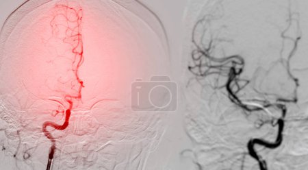 Photo for A cerebral angiogram is a medical imaging procedure used to examine blood vessels in the brain. This procedure helps diagnose conditions like aneurysms, strokes, or vessel abnormalities. - Royalty Free Image