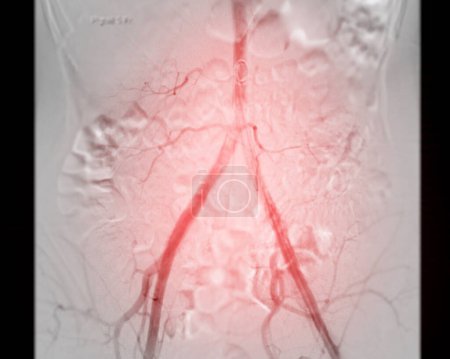 Téléchargez les photos : Un angiogramme fémoral est une procédure médicale utilisée pour visualiser les vaisseaux sanguins dans la région de l'aine. - en image libre de droit