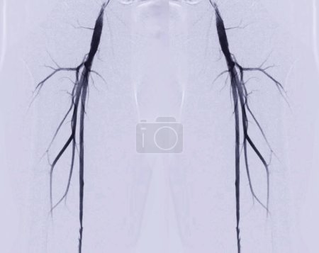 Photo for A Femoral Angiogram is a medical procedure used to visualize blood vessels in the groin area. - Royalty Free Image