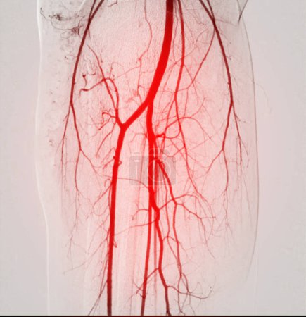 Téléchargez les photos : Un angiogramme fémoral est une procédure médicale utilisée pour visualiser les vaisseaux sanguins dans la région de l'aine. - en image libre de droit