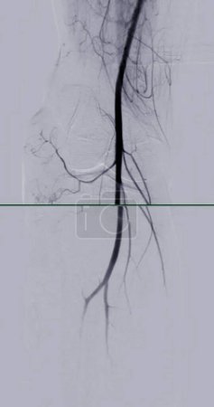 Foto de Un angiograma femoral es un procedimiento médico utilizado para visualizar los vasos sanguíneos en el área de la ingle.. - Imagen libre de derechos