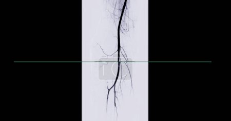 Foto de Un angiograma femoral es un procedimiento médico utilizado para visualizar los vasos sanguíneos en el área de la ingle.. - Imagen libre de derechos