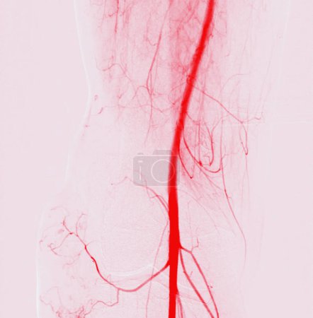 Photo for A Femoral Angiogram is a medical procedure used to visualize blood vessels in the groin area. - Royalty Free Image
