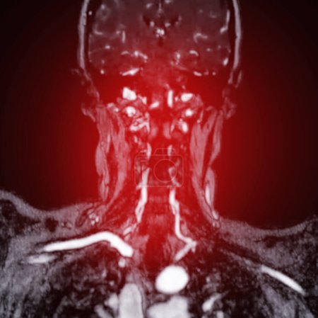 Téléchargez les photos : ARM Angiographie du cerveau et du cou ou angiographie par résonance magnétique (ARM) de l'artère cérébrale et de l'artère carotide commune pour les évaluer sténose et AVC
. - en image libre de droit