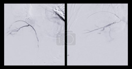 Photo for X-ray image of TACE or Chemoembolization is a procedure that allows a dose of chemotherapy drugs to be administered directly to Liver tumor or HCC. - Royalty Free Image