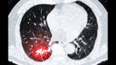 CT scan of Chest or lung  axial viewshowing lung cancer lung cancer .