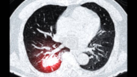Photo for CT scan of Chest or lung  axial viewshowing lung cancer lung cancer . - Royalty Free Image