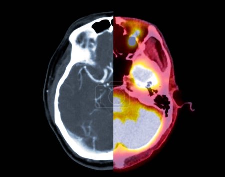 Tomografía computarizada del cerebro Vista axial y PET TAC SCAN.