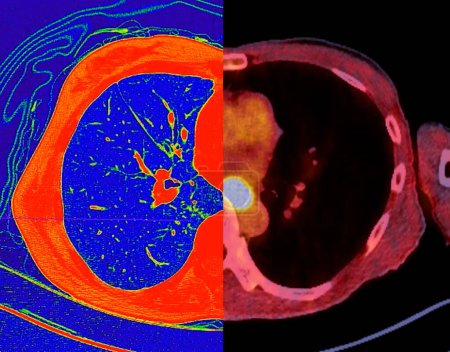 Foto de Tomografía computarizada de la vista axial del tórax en modo de color e imagen PET CT SCAN. - Imagen libre de derechos