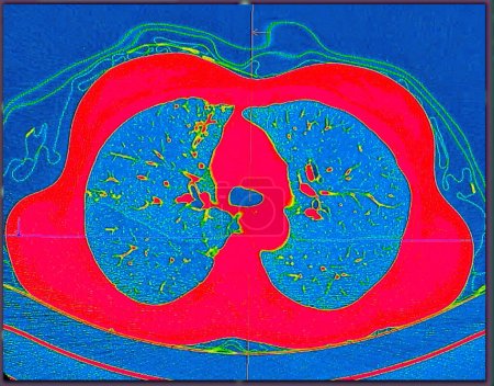 Foto de Tomografía computarizada de tórax Vista axial en modo de color para diagnóstico Embolia pulmonar (EP), cáncer de pulmón y covid-19. - Imagen libre de derechos