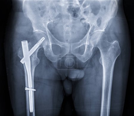 Une radiographie révèle les deux articulations de la hanche avec hémiarthroplastie, montrant le succès de l'intervention chirurgicale et fournissant un témoignage visuel de la mobilité et de la fonction restaurées.