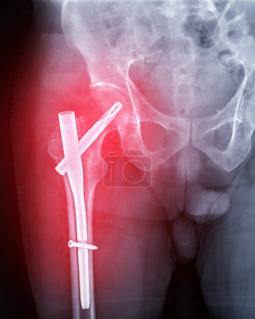 Una radiografía revela ambas articulaciones de la cadera con hemiartroplastia, mostrando el éxito del procedimiento quirúrgico y proporcionando un testamento visual a la movilidad y función restauradas..