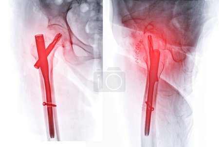 Ein Röntgenbild zeigt beide Hüftgelenke mit Hemiarthroplastik, was den Erfolg des chirurgischen Eingriffs veranschaulicht und ein visuelles Zeugnis der wiederhergestellten Beweglichkeit und Funktion darstellt..