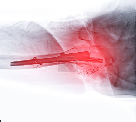 Una radiografía revela ambas articulaciones de la cadera con hemiartroplastia, mostrando el éxito del procedimiento quirúrgico y proporcionando un testamento visual a la movilidad y función restauradas..