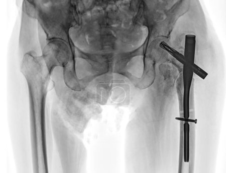 Photo for An X-ray reveals both hip joints with hemiarthroplasty, showcasing the success of the surgical procedure and providing a visual testament to the restored mobility and function. - Royalty Free Image