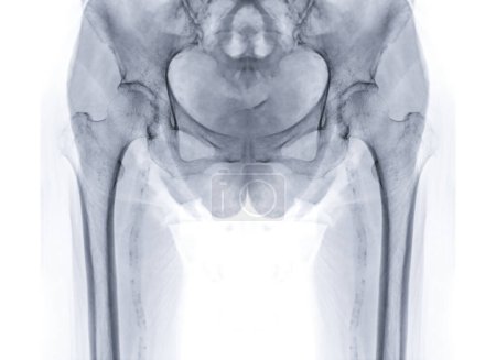 Photo for An X-ray reveals both hip joints with prosthetic replacements, showcasing the success of the surgical procedure and providing a visual testament to the restored mobility and function. - Royalty Free Image