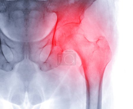 Photo for An X-ray reveals both hip joints in normal study. - Royalty Free Image