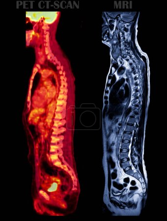 Photo for A PET-CT scan image and MRI Screening whole spine sagittal view. - Royalty Free Image