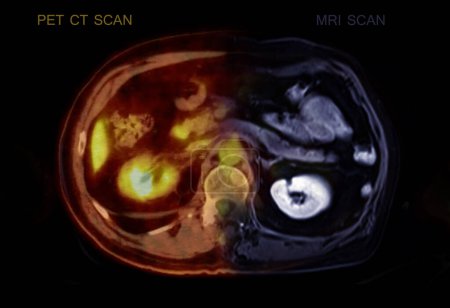 A PET-CT scan image and MRI Abdomen.