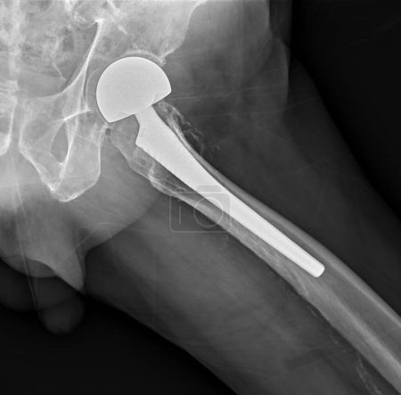 Une radiographie révèle les deux articulations de la hanche avec ARTHROPLASTÉ TOTAL HIP, montrant le succès de l'intervention chirurgicale et fournissant un témoignage visuel de la mobilité et de la fonction restaurées.