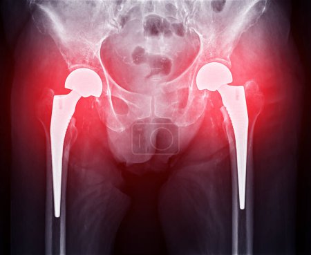 Ein Röntgenbild zeigt beide Hüftgelenke mit TOTAL HIP ARTHROPLASTY, was den Erfolg des chirurgischen Eingriffs veranschaulicht und ein visuelles Zeugnis für die wiederhergestellte Beweglichkeit und Funktion darstellt..