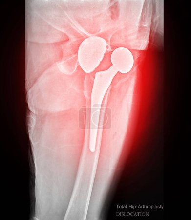 Une radiographie révèle les deux articulations de la hanche avec prothèses de remplacement, mettant en valeur la luxation des prothèses de remplacement.