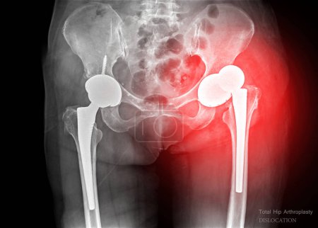 Una radiografía revela ambas articulaciones de cadera con reemplazos protésicos, mostrando dislocación de reemplazos protésicos.