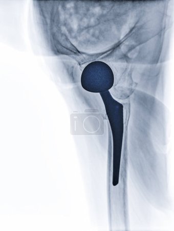 Ein Röntgenbild zeigt beide Hüftgelenke mit TOTAL HIP ARTHROPLASTY, was den Erfolg des chirurgischen Eingriffs veranschaulicht und ein visuelles Zeugnis für die wiederhergestellte Beweglichkeit und Funktion darstellt..