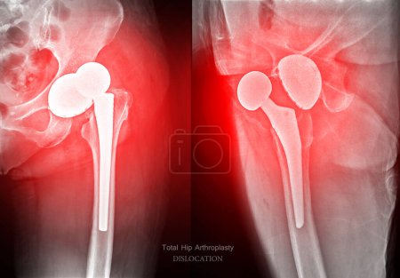 An X-ray reveals both hip joints with prosthetic replacements, showcasing Dislocation of prosthetic replacements.