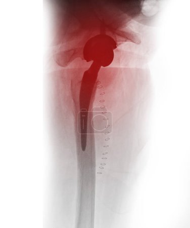 Photo for An X-ray reveals both hip joints with TOTAL HIP ARTHROPLASTY, showcasing the success of the surgical procedure and providing a visual testament to the restored mobility and function. - Royalty Free Image