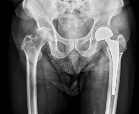 Una radiografía revela ambas articulaciones de cadera con artroplastia TOTAL HIP, mostrando el éxito del procedimiento quirúrgico y proporcionando un testamento visual a la movilidad y función restauradas..