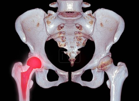 Una radiografía revela ambas articulaciones de cadera con artroplastia TOTAL HIP, mostrando el éxito del procedimiento quirúrgico y proporcionando un testamento visual a la movilidad y función restauradas..