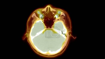 Téléchargez les photos : Une image de TEP-TDM est une visualisation diagnostique combinant la tomographie par émission de positrons (TEP) et la tomodensitométrie (TDM) pour aider à trouver la récurrence du cancer. - en image libre de droit