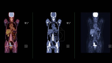 Téléchargez les photos : Une image de TEP-TDM est une visualisation diagnostique combinant la tomographie par émission de positrons (TEP) et la tomodensitométrie (TDM) pour aider à trouver la récurrence du cancer. - en image libre de droit