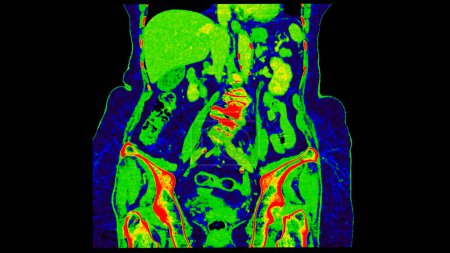CT-Scan der koronalen Ansicht des Abdomens mit Injektionskontrastmedien mit grüner Farbmodus koronaler Ansicht zur Diagnose von Abdominalerkrankungen.