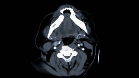 Foto de Tomografía computarizada del cerebro Vista axial para el diagnóstico de tumores cerebrales, derrames cerebrales y enfermedades vasculares. - Imagen libre de derechos