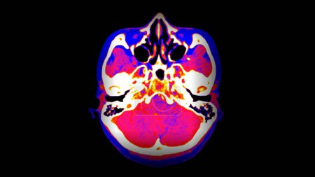 Foto de Tomografía computarizada Perfusión cerebral o tomografía computarizada de la vista axial cerebral . - Imagen libre de derechos
