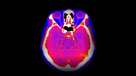 Foto de Tomografía computarizada Perfusión cerebral o tomografía computarizada de la vista axial cerebral . - Imagen libre de derechos