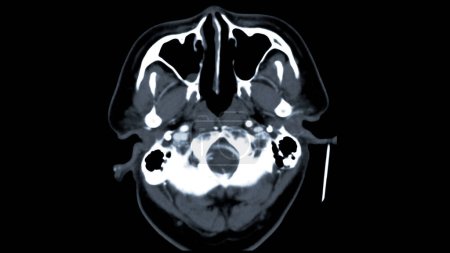 Tomografía computarizada del cerebro Vista axial para el diagnóstico de tumores cerebrales, derrames cerebrales y enfermedades vasculares.