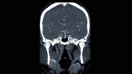 Tomografía computarizada del cerebro Vista coronal para el diagnóstico de tumores cerebrales, derrames cerebrales y enfermedades vasculares.
