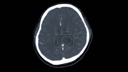 Tomografía computarizada del cerebro Vista axial para el diagnóstico de tumores cerebrales, derrames cerebrales y enfermedades vasculares.