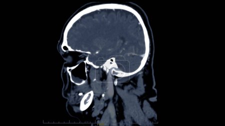 Tomografía computarizada de la vista sagital cerebral para el diagnóstico de tumores cerebrales, derrames cerebrales y enfermedades vasculares.