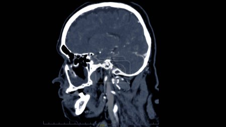 Tomografía computarizada de la vista sagital cerebral para el diagnóstico de tumores cerebrales, derrames cerebrales y enfermedades vasculares.
