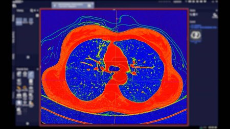 Foto de Tomografía computarizada de tórax Vista axial en modo de color para diagnóstico Embolia pulmonar (EP), cáncer de pulmón y covid-19. - Imagen libre de derechos