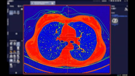 Tomografía computarizada de tórax Vista axial en modo de color para diagnóstico Embolia pulmonar (EP), cáncer de pulmón y covid-19. 