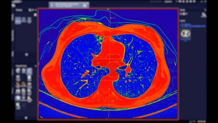 CT scan of Chest Axial view in color mode for diagnostic Embolie pulmonaire (EP), cancer du poumon et covide-19. 