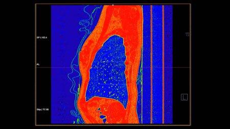 CT Scan der Brust sagittale Ansicht im Farbmodus für diagnostische Lungenembolie (PE), Lungenkrebs und Covid-19. 